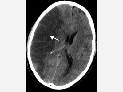 UMass Memorial - Milford Regional Stroke Certification  